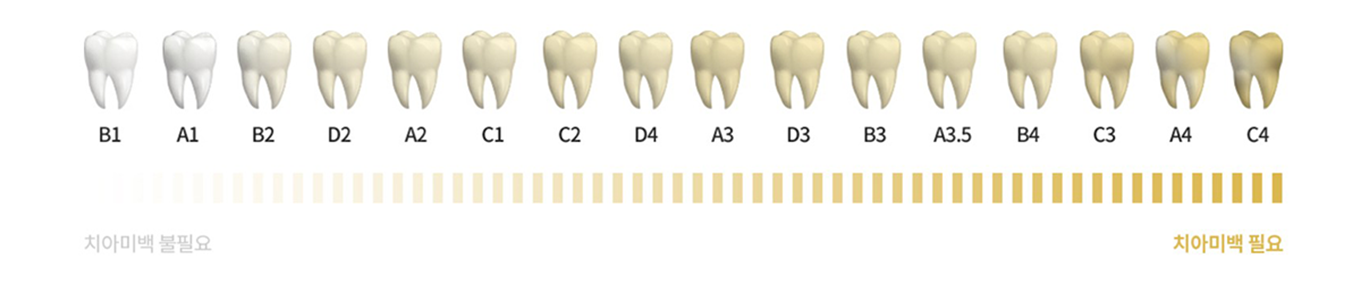 치아미백 색상 가이드